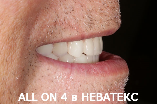 алл он фо протезы фото вид сбоку алонфо фото вид сбоку